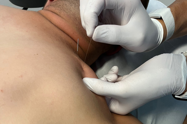 dry-needling